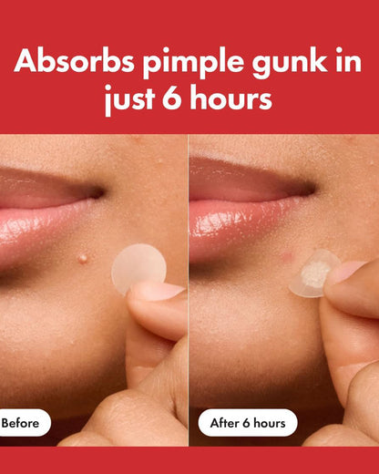 Mighty Patch Original - Hydrocolloid Acne Pimple Patch